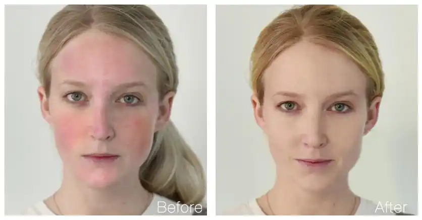 护肤前后效果对比9)电穿孔导入:不破坏细胞结构,开启细胞吸收通道