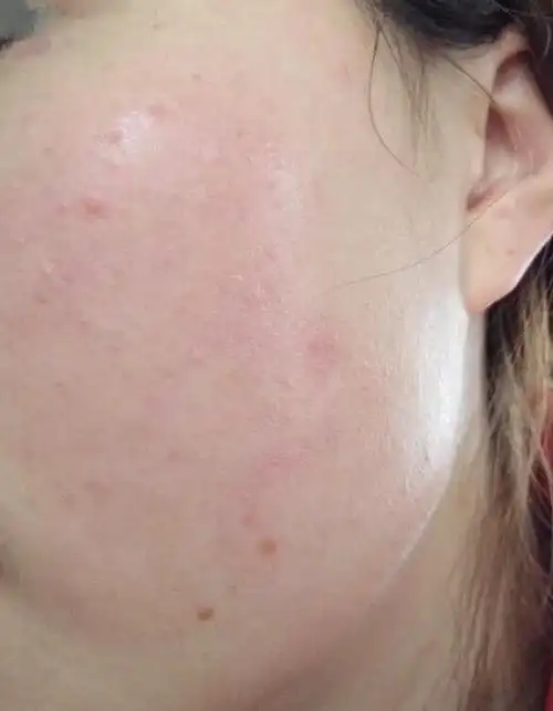 您好丁教授我是一个敏感肌肤患者我的皮肤经常过敏出现红