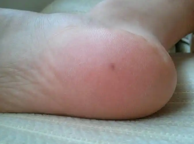 后天长得,刚开始时周围还有9个小点点,跟麻将九饼似的,现在九饼不见了