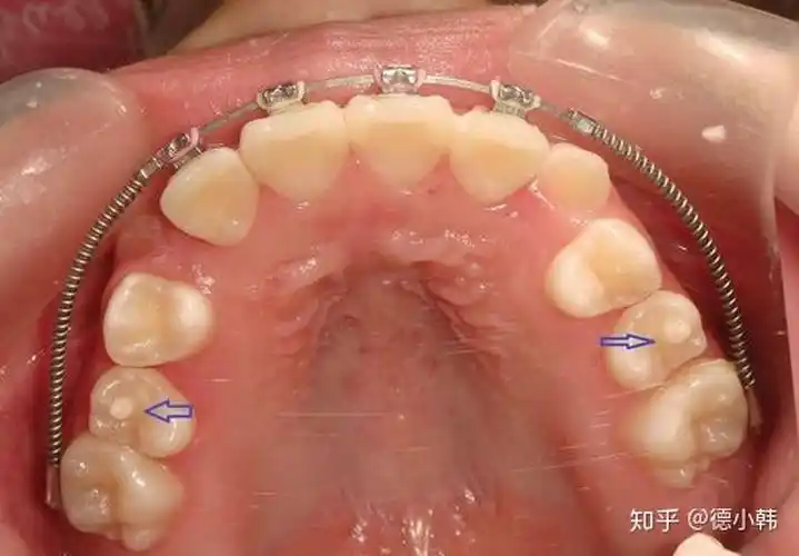 怎么处理畸形中央尖