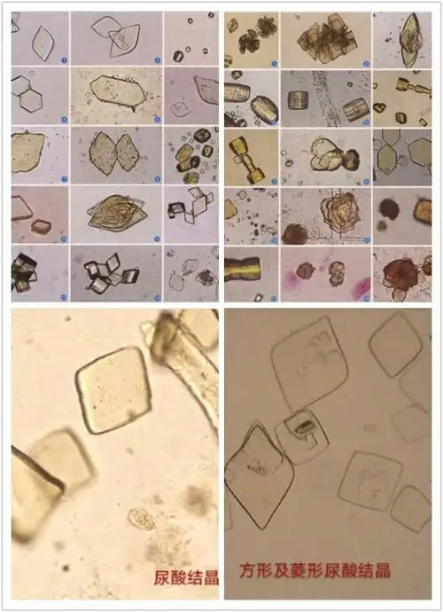 六边形的尿酸结晶与胱氨酸结晶形态相似,应注意鉴别.