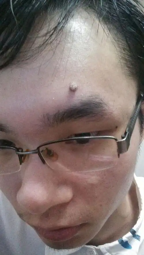 额头上长了个黄豆的小肉球,不知道是什么.