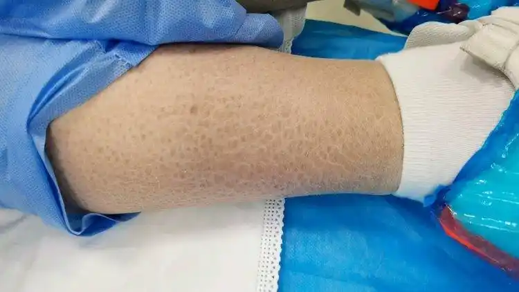 皮肤角质化色素沉着