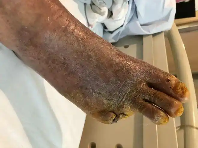 萧山一大伯竟把自己的脚趾切了?