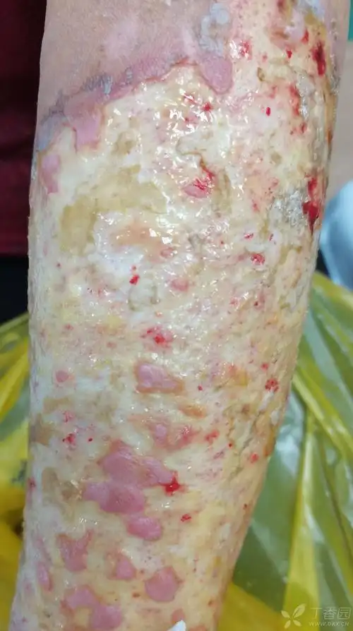 左前臂及左手背开水烫伤