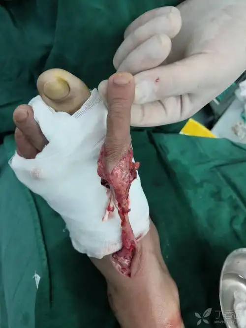 【讨论】足趾移植再造示指 [精华] [病例帖]