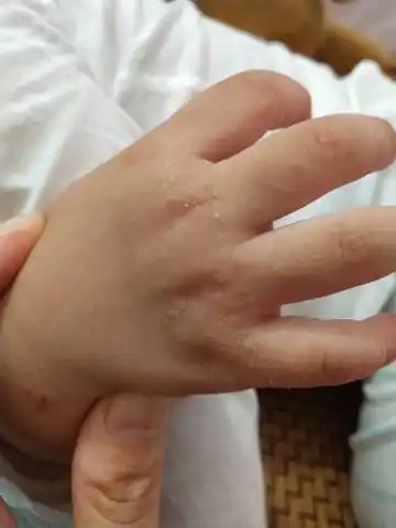 还没好,大家有什麼好的治疗方法推荐