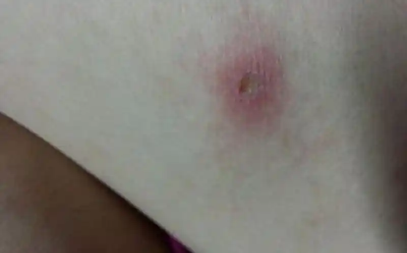 一期梅毒具体该怎么治疗图片一期梅毒溃疡图片一期梅毒临床的表现图片