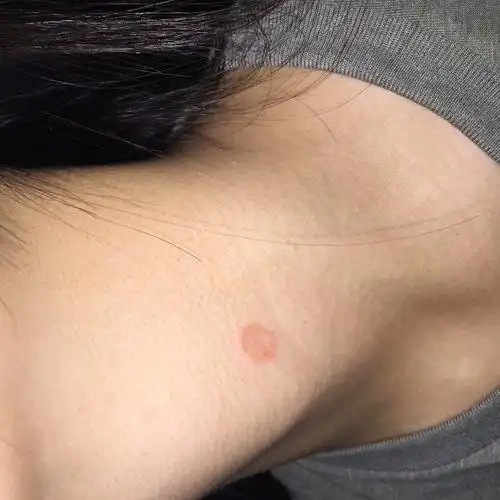 脖子上长了一个圆的东西没什么感觉有时候会感觉微微刺痒