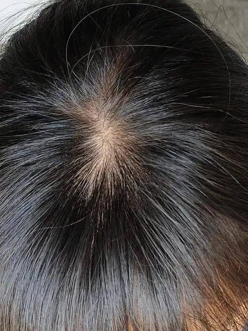 大学生三甲医院看脱发记20岁