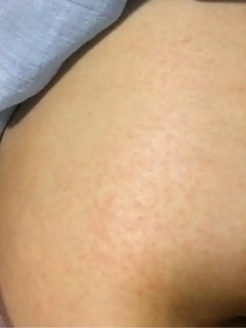 孕7个月,今天突然发现肚子上张了红斑,红点点怎么回事