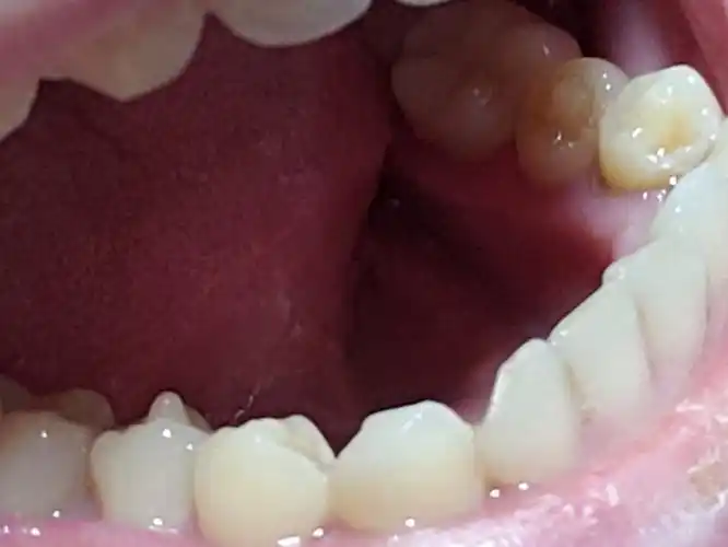 我的畸形中央尖