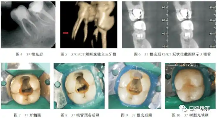 下颌第二磨牙3牙根伴近中3根管1例