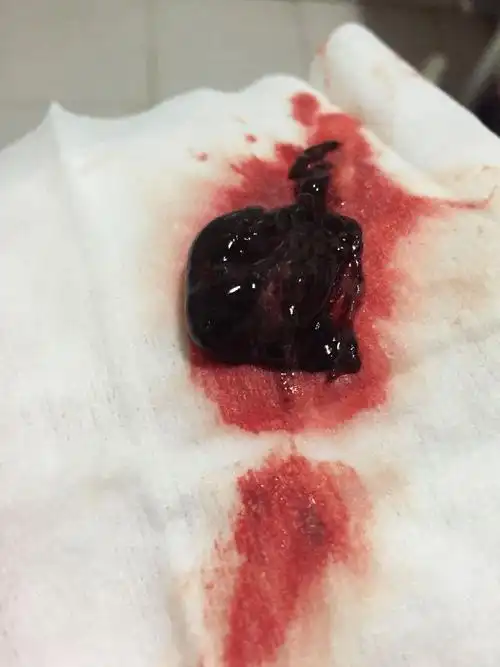 早期出现阴道出血,量多,排出白色圆形或者椭圆形孕囊组织是流产的标志