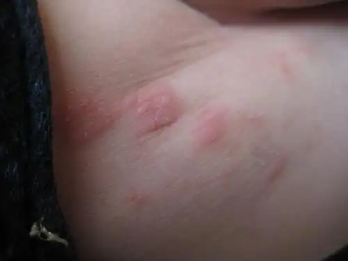 湿巾给娃擦屁股,三天就湿疹遍布,湿巾背锅?还是宝妈太糊涂?