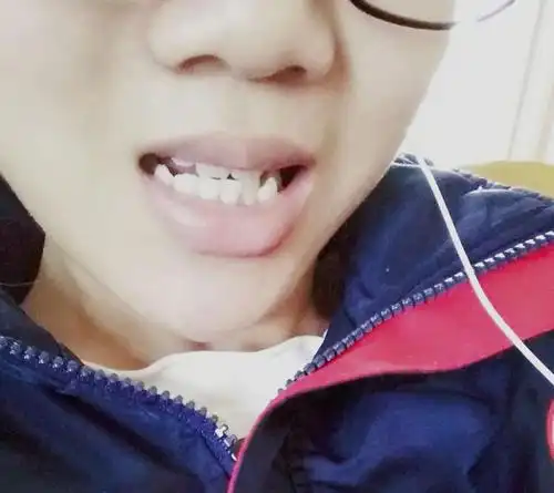 虎牙太尖是什么梗