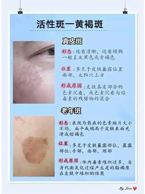 你的黄褐斑属于哪一种类形不同部位长斑的