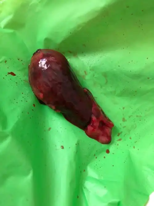 请问这个是孕囊吗?出血怀疑先兆流产腹痛一夜排出来的.