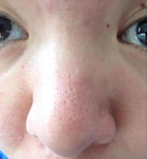 毛孔特别粗大,有人有良方推荐吗?