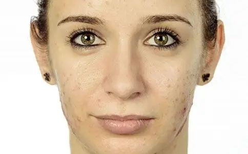 夏天痘痘肌肤可以涂防晒霜吗