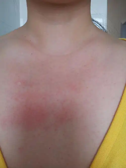 就是一点点凸起的小点,里面可以挤出脂肪粒一样的东西,有时候一片发红