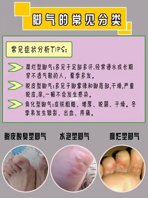 水泡脚气终于好啦!05‖水泡终于没啦!