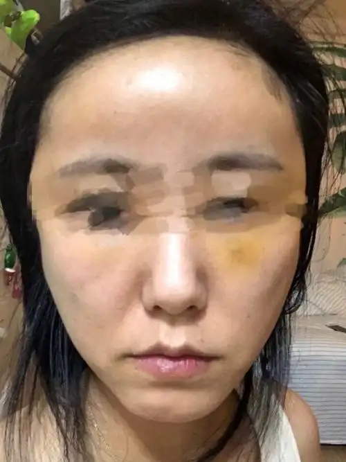 脂肪填充做了有1年多,恢_圈子-新氧美容整形