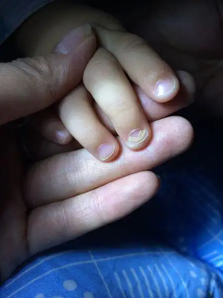 问:我的宝宝一岁多,手指甲长两层?是怎么回事?大家知道吗?