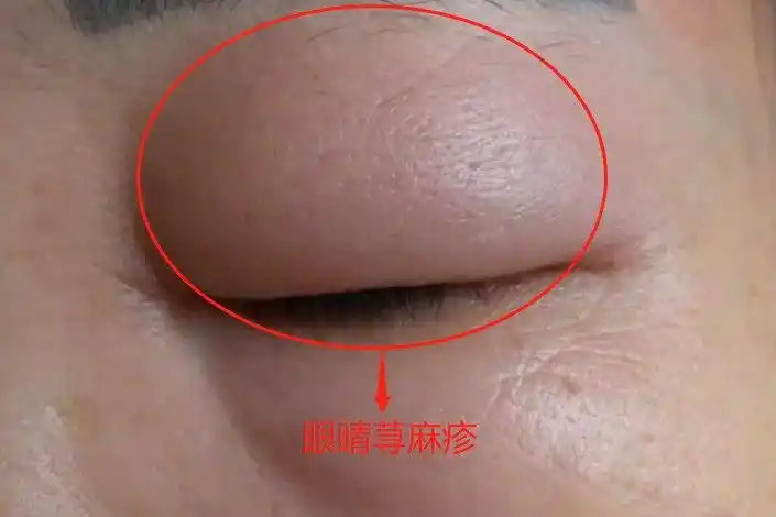 眼睛荨麻疹以眼睑部位水肿为主,一般为双侧对称性的,部分患者也可以是