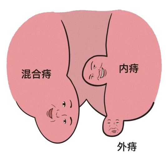 有痔疮的人,将经历什么?