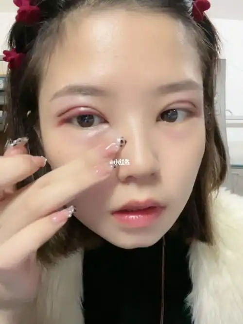 割完双眼皮第二天