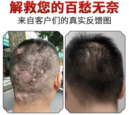 头皮毛囊有炎洗发水露治疗脓包痤疮背部痘疙瘩去螨虫除螨深层清洁