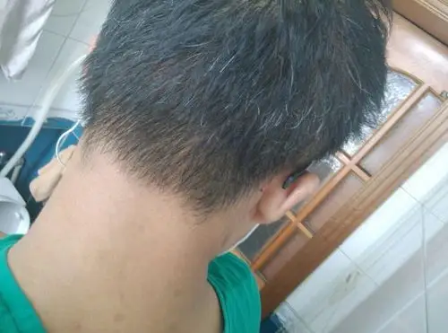 今年16岁 后脑勺白头发特别多 什么原因?