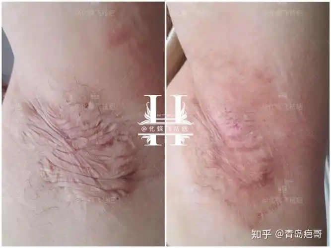 十几年的腋下手术疤痕,太严重了