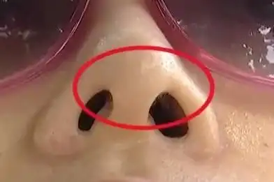 女子在南昌方大医疗美容隆鼻结果鼻孔一大一小