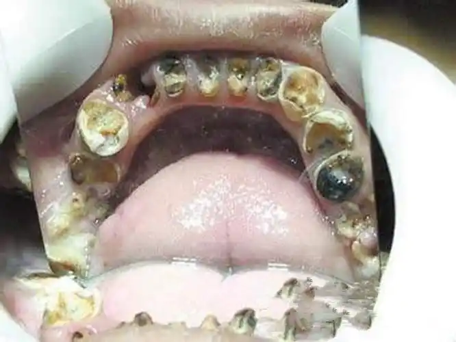 严重龋齿的图片_有来医生