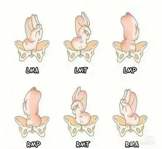 胎位不正胎位纠正