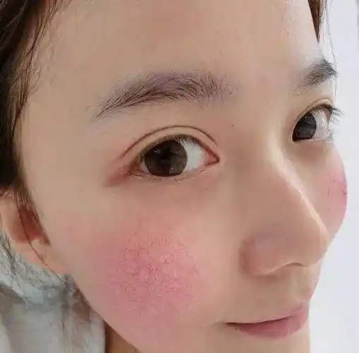 敏感红血丝皮肤
