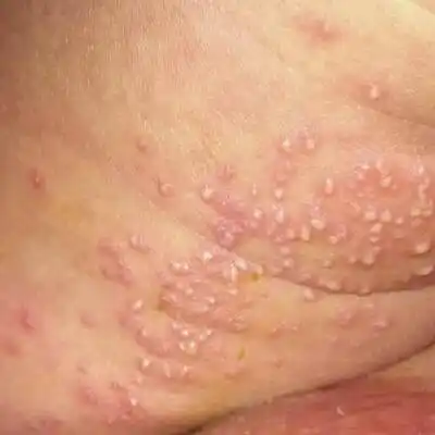 小孩这大腿内侧长的是湿疹吗_宝宝树