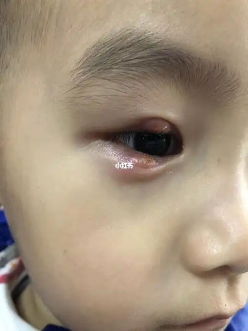 小宝霰粒肿治疗中1
