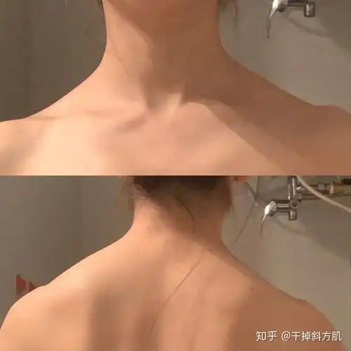 有专业的小伙伴吗?能帮我看看我的肩膀吗?这中是属于斜方肌过厚吗?