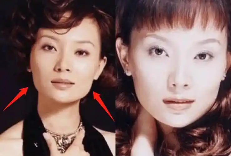 而削骨又会导致脸上挂不住肉,因此随着陈数年纪增长,她的整容后遗症就