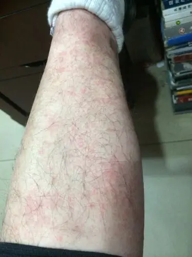 全身都是这样的症状这是什么病,痒,颈部