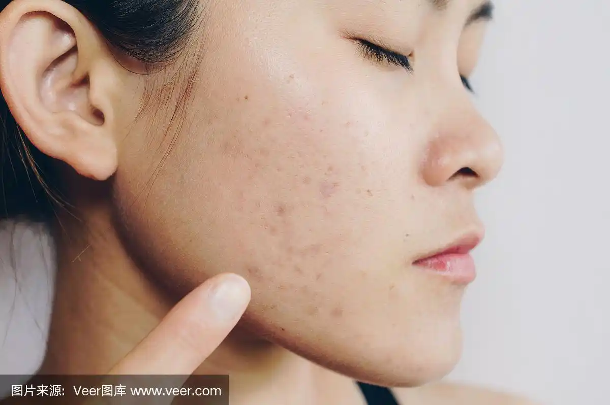 女人,人的脸部,问题,亚洲,皮肤