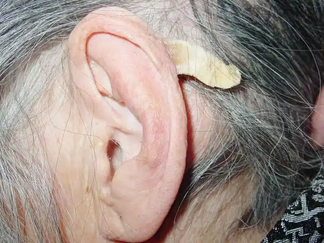 耳廓皮角 - 好大夫在线