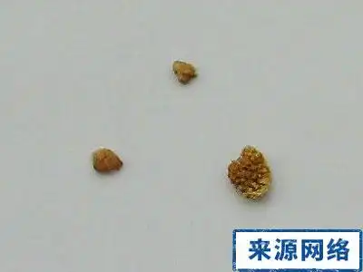 尿酸结石的尿酸结石成石机制与病因_百度知道