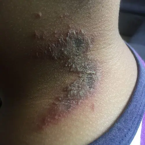 脖子后长了一片红红的有水泡,麻麻的碰了会痛但不痒,是什么?用什么