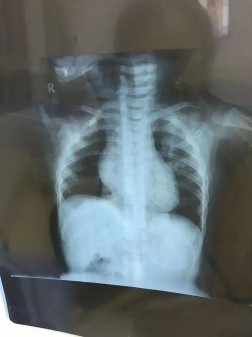 宝宝一岁支气管肺炎