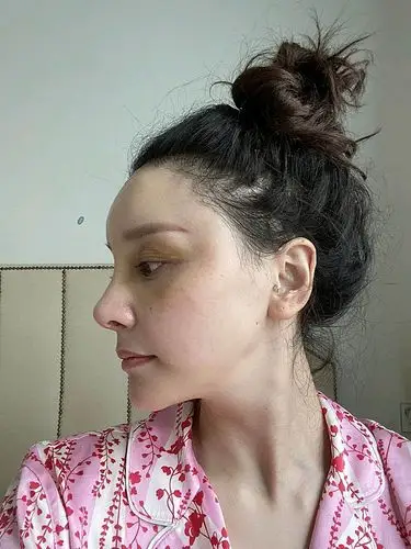 全脸大改造(鼻修复 小切口拉皮 小项目)术后21天_圈子-新氧美容整形