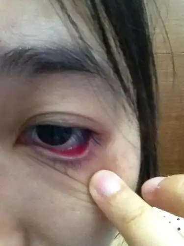 眼睛疼什么意思,就下眼睑!有一点点肿了,里面很红,一直带隐形眼镜